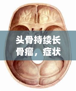 頭骨持續(xù)長骨瘤，癥狀、成因與治療方案深度解析