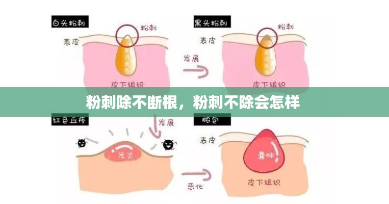 粉刺除不斷根，粉刺不除會怎樣 