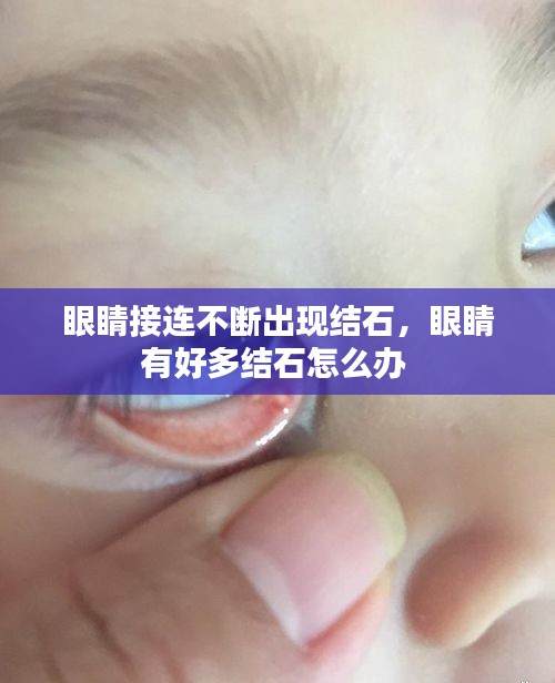 眼睛接連不斷出現(xiàn)結(jié)石，眼睛有好多結(jié)石怎么辦 