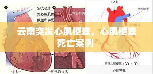 云南突發(fā)心肌梗塞，心肌梗塞死亡案例 
