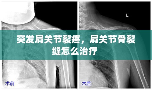 突發(fā)肩關(guān)節(jié)裂疼，肩關(guān)節(jié)骨裂縫怎么治療 