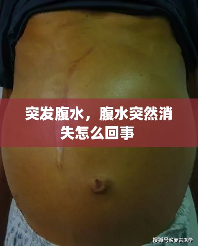 突發(fā)腹水，腹水突然消失怎么回事 