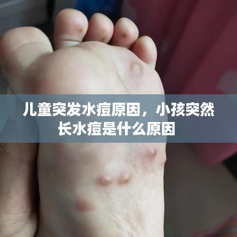 兒童突發(fā)水痘原因，小孩突然長水痘是什么原因 