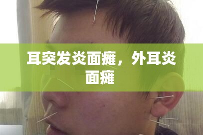 耳突發(fā)炎面癱，外耳炎面癱 