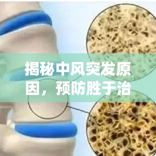 揭秘中風(fēng)突發(fā)原因，預(yù)防勝于治療！