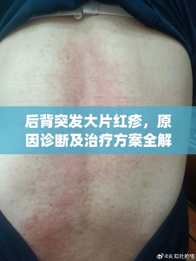 后背突發(fā)大片紅疹，原因診斷及治療方案全解析