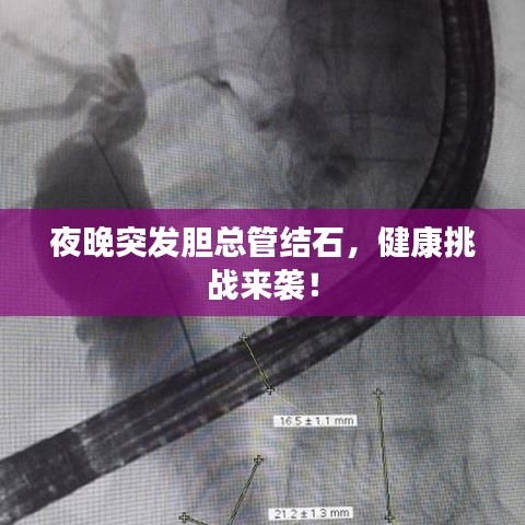 夜晚突發(fā)膽總管結石，健康挑戰(zhàn)來襲！