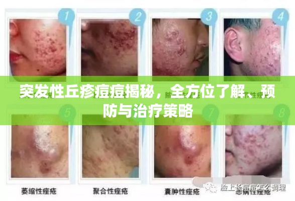 突發(fā)性丘疹痘痘揭秘，全方位了解、預防與治療策略